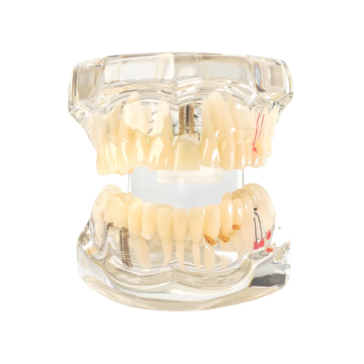 Evodent Signature All In One Model With Three Implant Fpd - Dental Implant Patient Education Model | Buy Now At Evodent Evodent signature all in one model with three implant fpd - dental implant patient education model