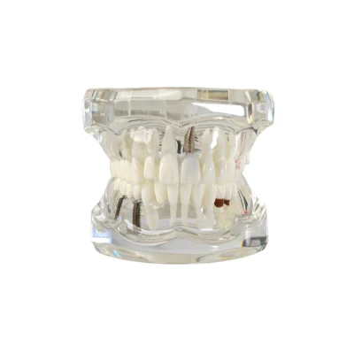 Evodent Signature All In One With Three Implant Evodent signature all in one with three implant