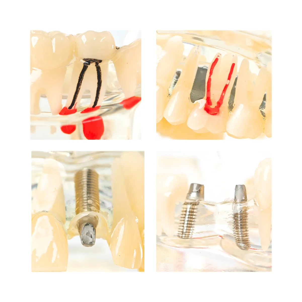 Evodent Signature All In One Model With Three Implant Fpd - Dental Implant Patient Education Model | Buy Now At Evodent Evodent signature all in one model with three implant fpd - dental implant patient education model