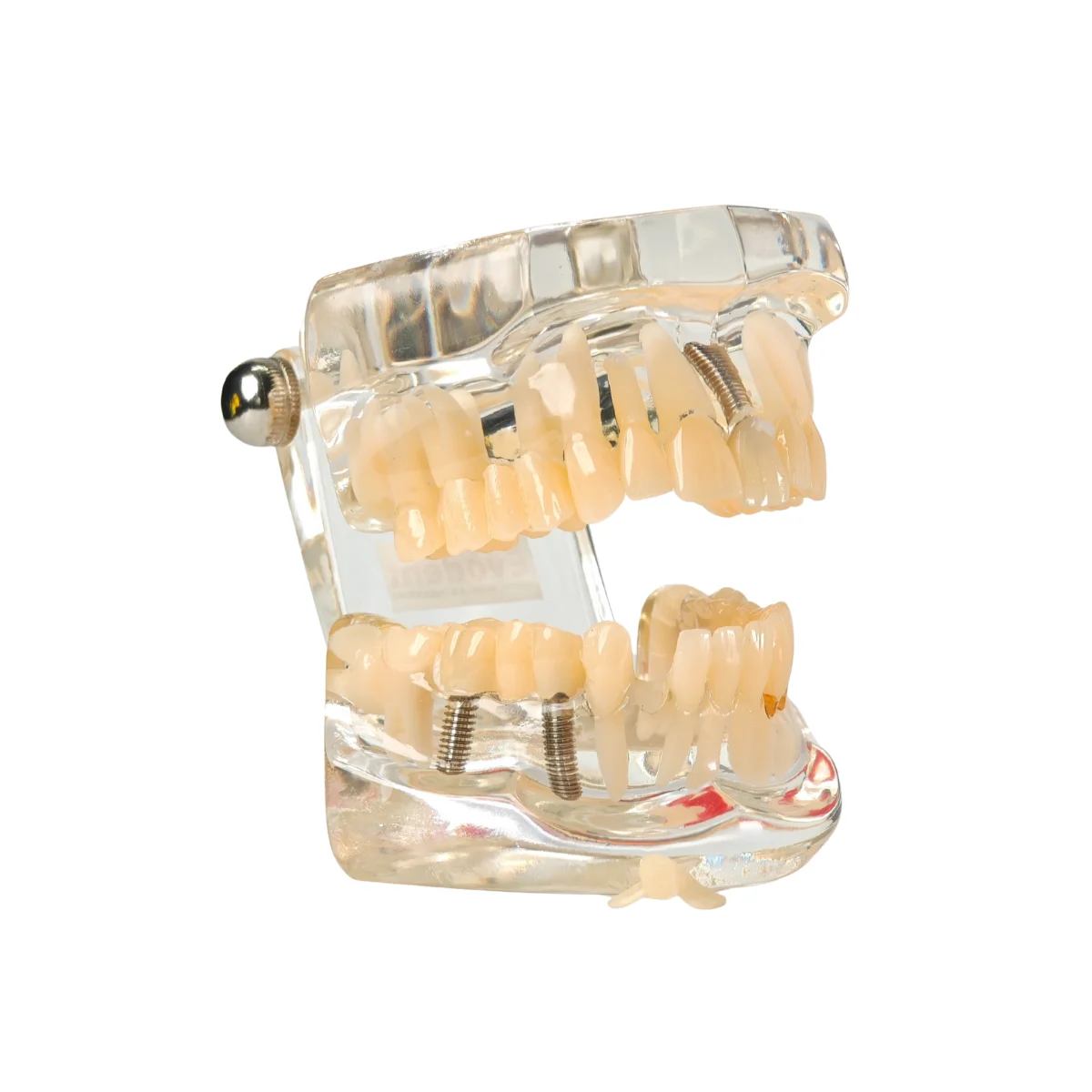 Evodent Signature All In One Model With Three Implant Fpd - Dental Implant Patient Education Model | Buy Now At Evodent Evodent signature all in one model with three implant fpd - dental implant patient education model