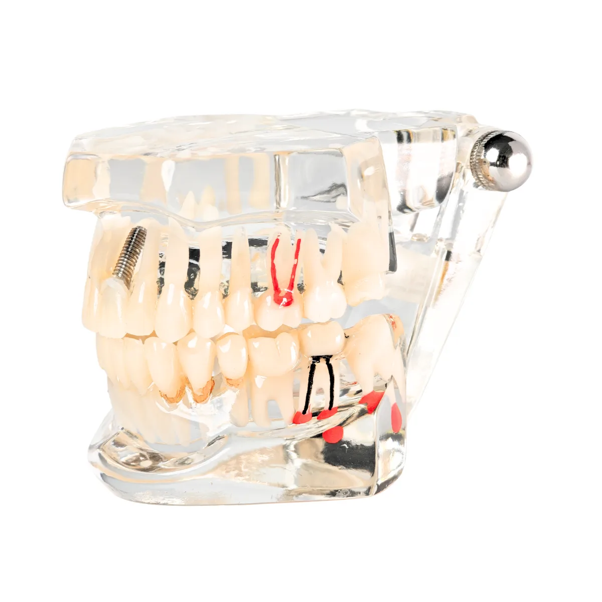 Evodent Signature All In One Model With Three Implant Fpd - Dental Implant Patient Education Model | Buy Now At Evodent Evodent signature all in one model with three implant fpd - dental implant patient education model