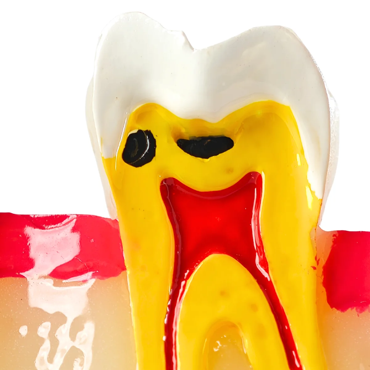 Evodent Signature Tooth Decay &Amp; Caries Progression Model - 6 Stage Patient Education Model | Buy Now At Evodent Evodent signature tooth decay & caries progression model - 6 stage patient education model