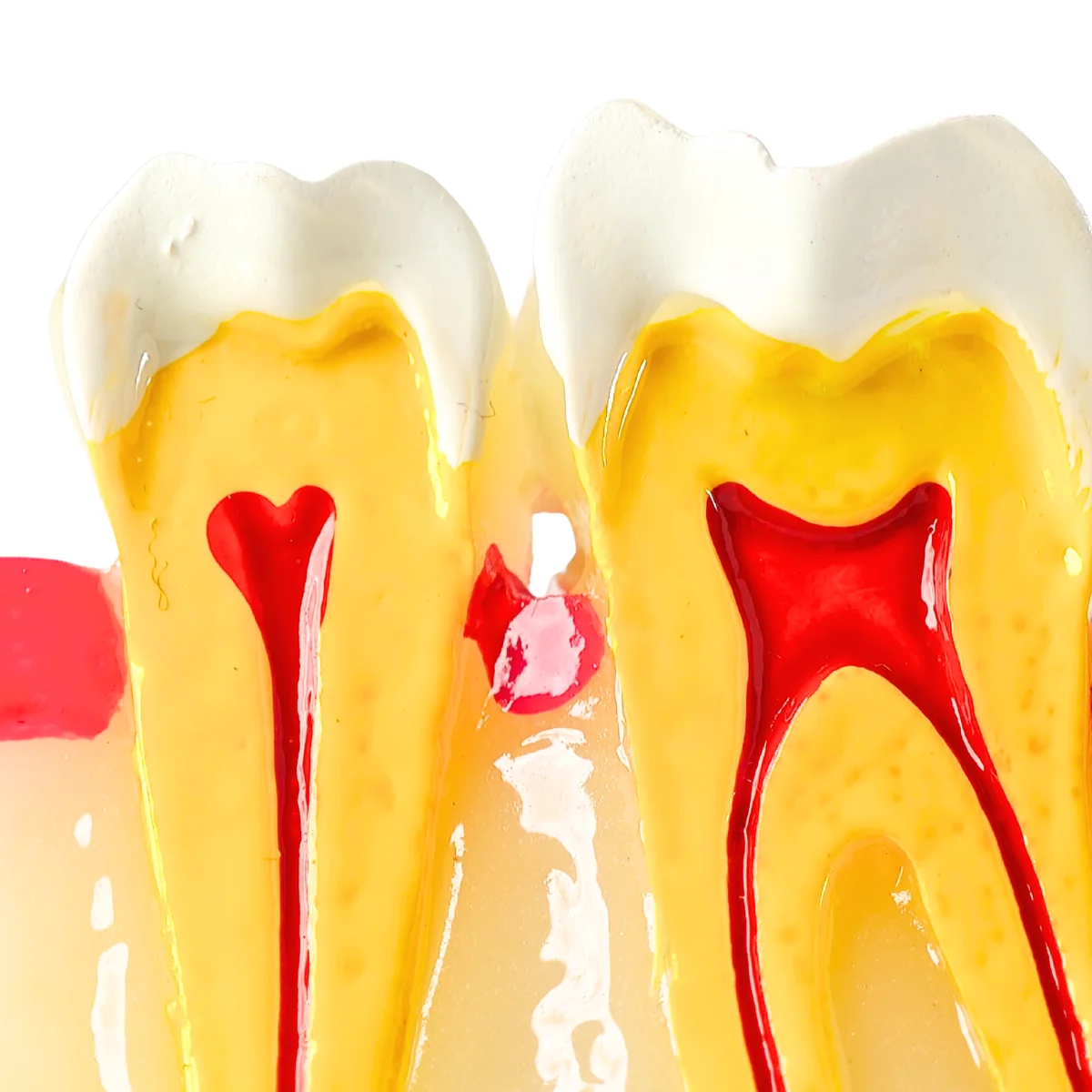 Evodent Signature Tooth Decay &Amp; Caries Progression Model - 6 Stage Patient Education Model | Buy Now At Evodent Evodent signature tooth decay & caries progression model - 6 stage patient education model