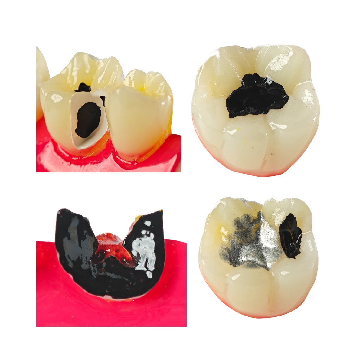 Evodent Signature Tooth Decay &Amp; Caries Progression Model - 6 Stage Patient Education Model | Buy Now At Evodent Evodent signature tooth decay & caries progression model - 6 stage patient education model