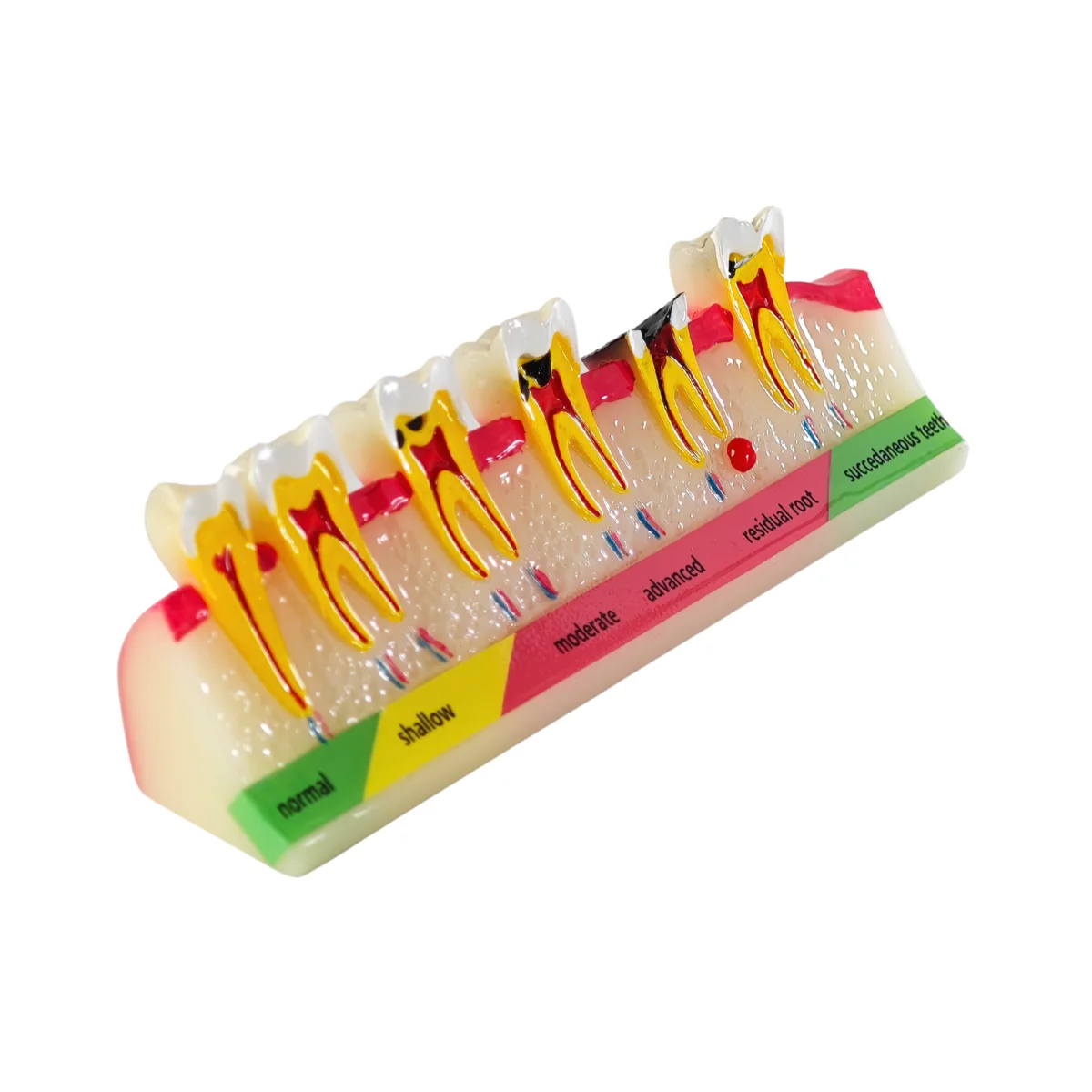 Evodent Signature Tooth Decay &Amp; Caries Progression Model - 6 Stage Patient Education Model | Buy Now At Evodent Evodent signature tooth decay & caries progression model - 6 stage patient education model