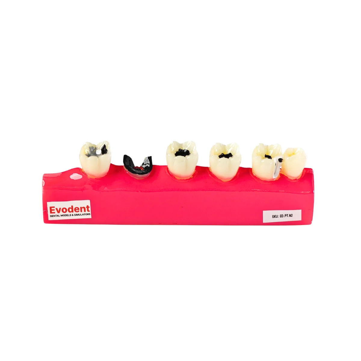 Evodent Signature Tooth Decay &Amp; Caries Progression Model - 6 Stage Patient Education Model | Buy Now At Evodent Evodent signature tooth decay & caries progression model - 6 stage patient education model