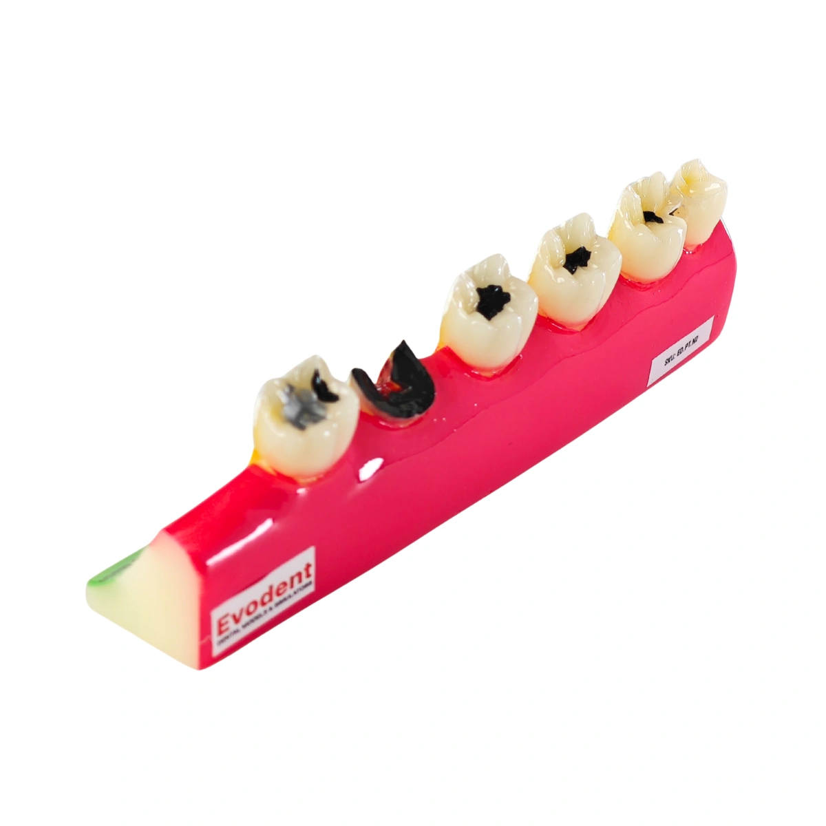 Evodent Signature Tooth Decay &Amp; Caries Progression Model - 6 Stage Patient Education Model | Buy Now At Evodent Evodent signature tooth decay & caries progression model - 6 stage patient education model