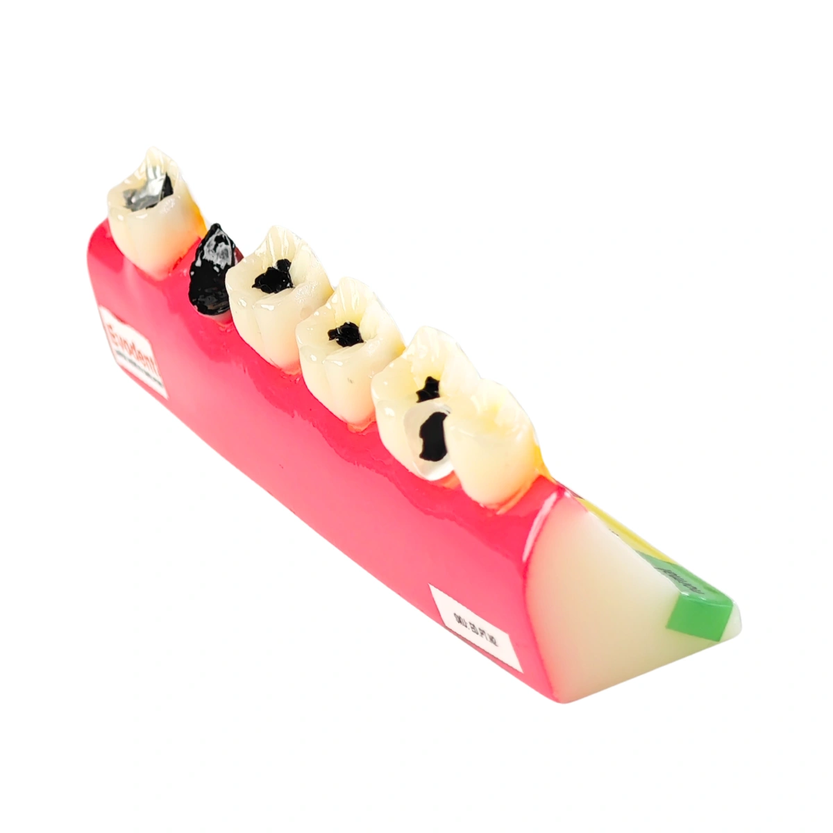 Evodent Signature Tooth Decay &Amp; Caries Progression Model - 6 Stage Patient Education Model | Buy Now At Evodent Evodent signature tooth decay & caries progression model - 6 stage patient education model