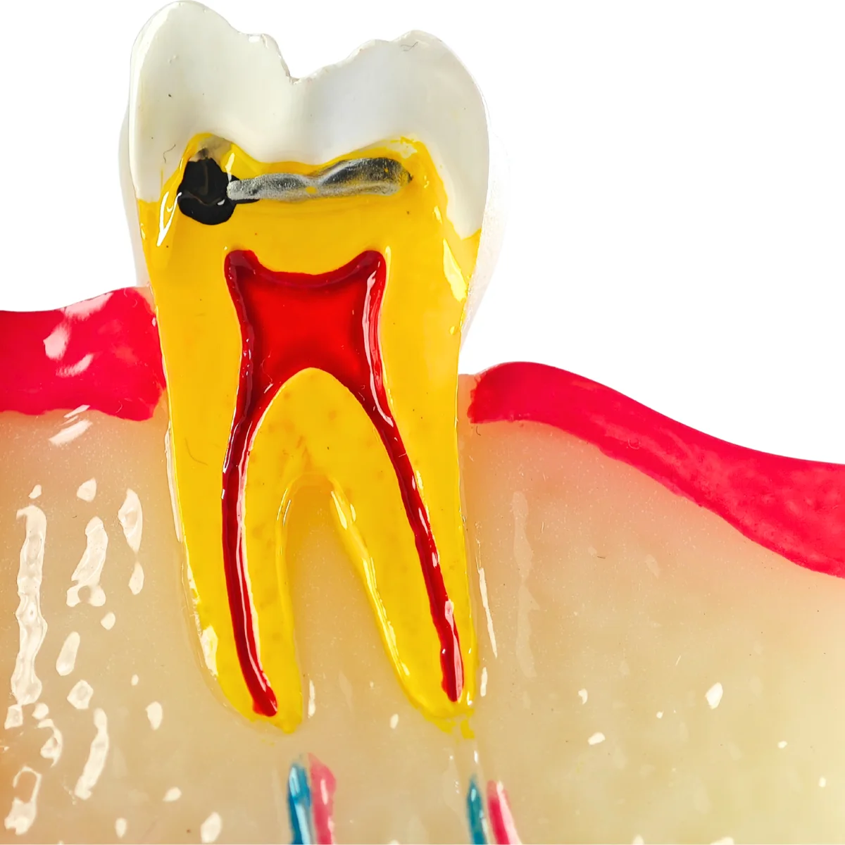 Evodent Signature Tooth Decay &Amp; Caries Progression Model - 6 Stage Patient Education Model | Buy Now At Evodent Evodent signature tooth decay & caries progression model - 6 stage patient education model