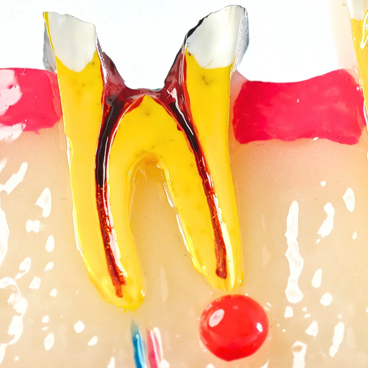 Evodent Signature Tooth Decay &Amp; Caries Progression Model - 6 Stage Patient Education Model | Buy Now At Evodent Evodent signature tooth decay & caries progression model - 6 stage patient education model