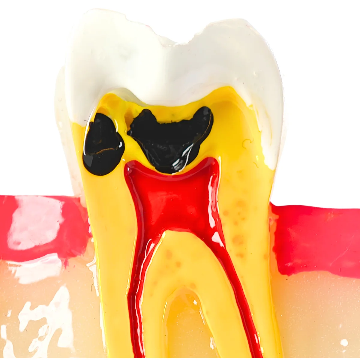Evodent Signature Tooth Decay &Amp; Caries Progression Model - 6 Stage Patient Education Model | Buy Now At Evodent Evodent signature tooth decay & caries progression model - 6 stage patient education model