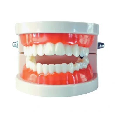 Evodent Model with Caries