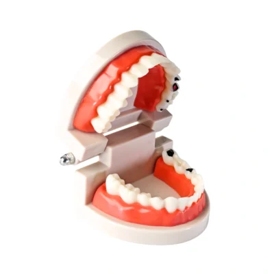 Evodent Dental Caries Demonstration Model – Tooth Decay & Cavity Progression Model for Patient Education