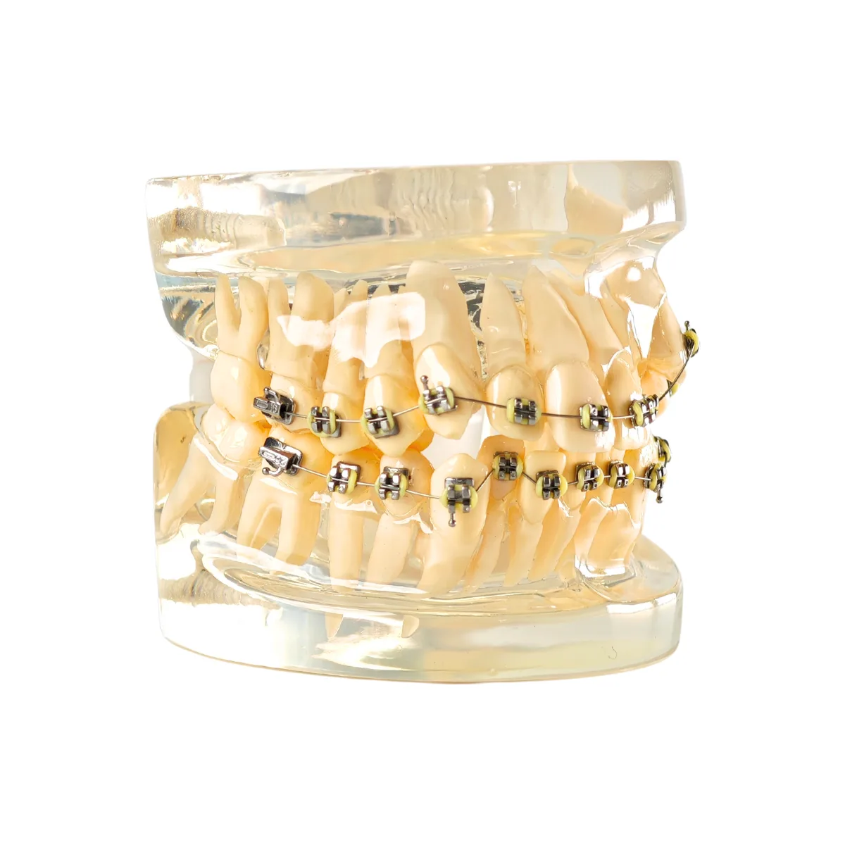 Evodent Signature Dental Malocculation Model With Metal Bracket, Patient Education Model | Buy Now At Evodent Evodent signature dental malocculation model with metal bracket, patient education model