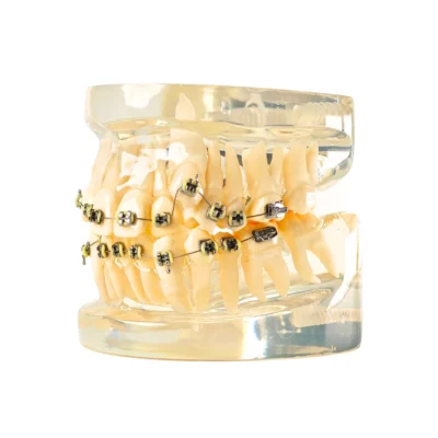 Evodent Signature Dental Malocculation Model with Metal Bracket, Patient Education Model