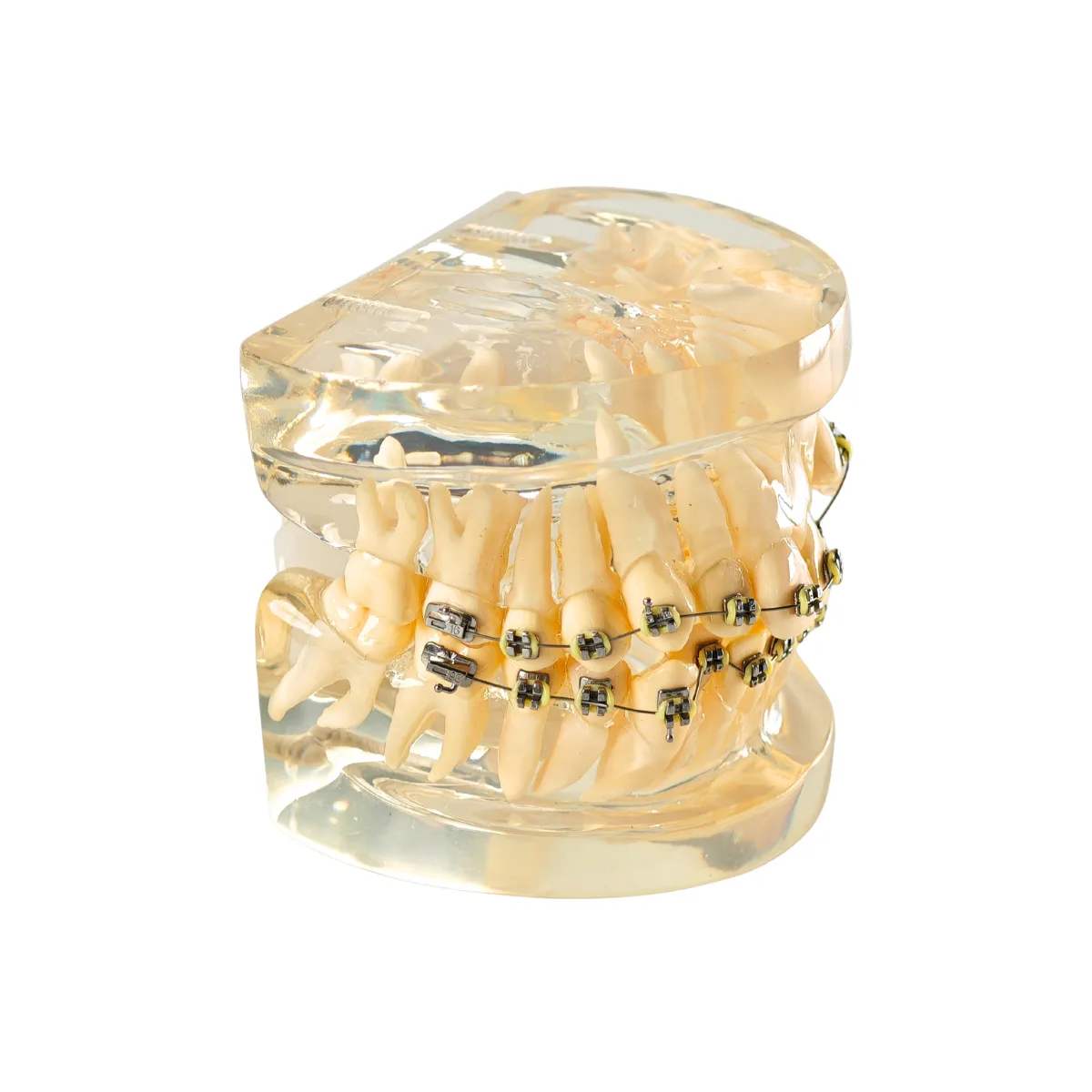 Evodent Signature Dental Malocculation Model With Metal Bracket, Patient Education Model | Buy Now At Evodent Evodent signature dental malocculation model with metal bracket, patient education model