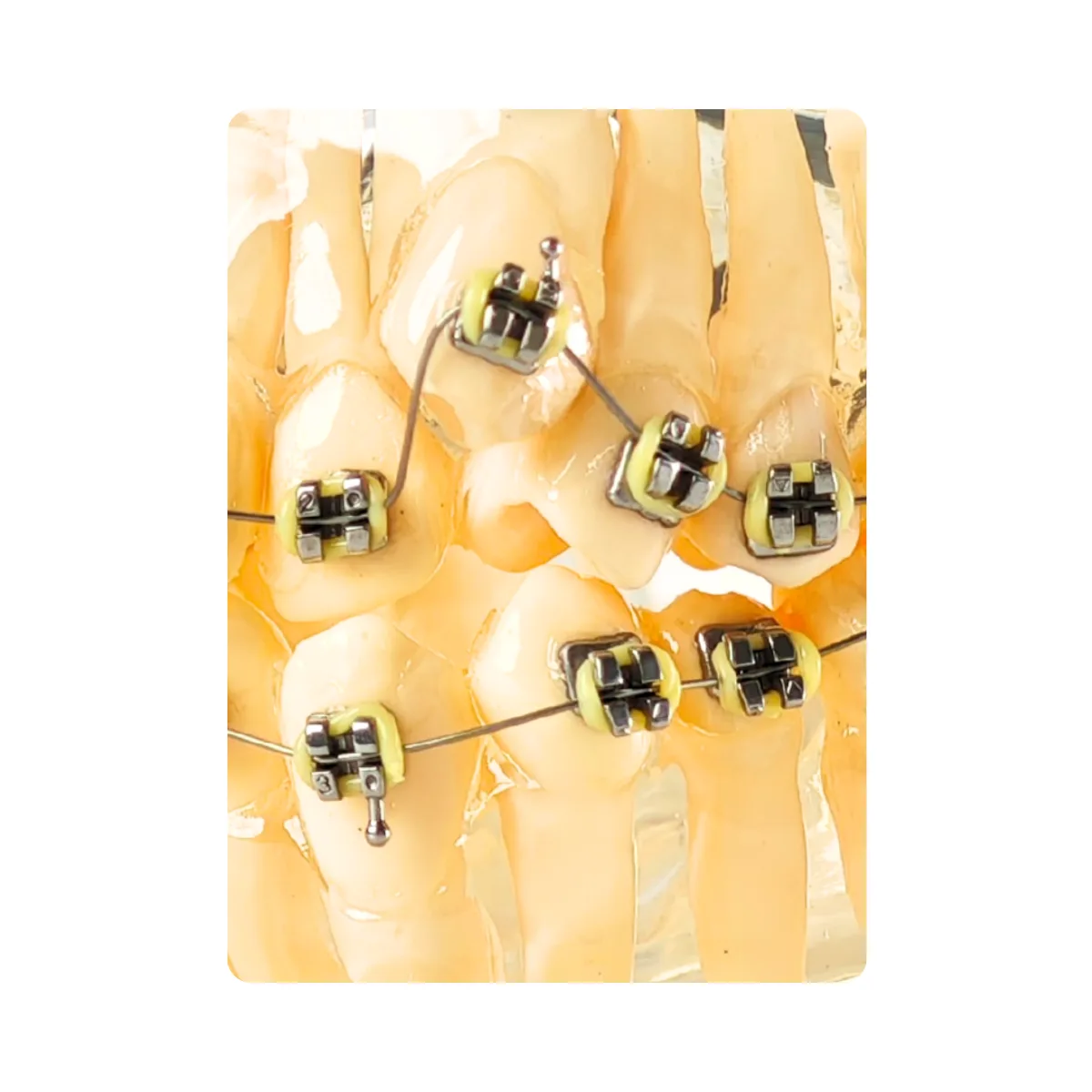 Evodent Signature Dental Malocculation Model With Metal Bracket, Patient Education Model | Buy Now At Evodent Evodent signature dental malocculation model with metal bracket, patient education model