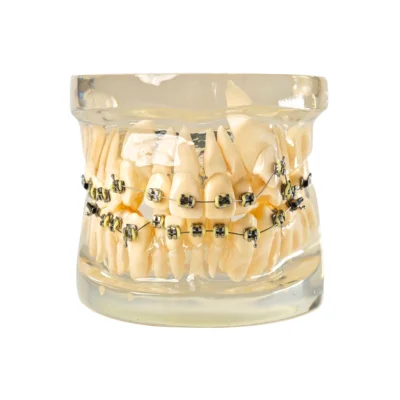 Evodent Signature Dental Malocculation Model with Metal Bracket, Patient Education Model Showing Transparent Base and Misaligned Teeth Dental Teaching.