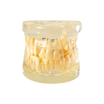 Evodent Orthodontic Model Class I Malocclusion Clear Base Demonstrating Normal Molar Relationship and Mild Dental Crowding for Dental Study and Patient Eductaion.