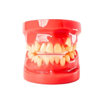 Evodent Orthodontic Model Class I Malocclusion Pink Base with Detailed Teeth Alignment Model.