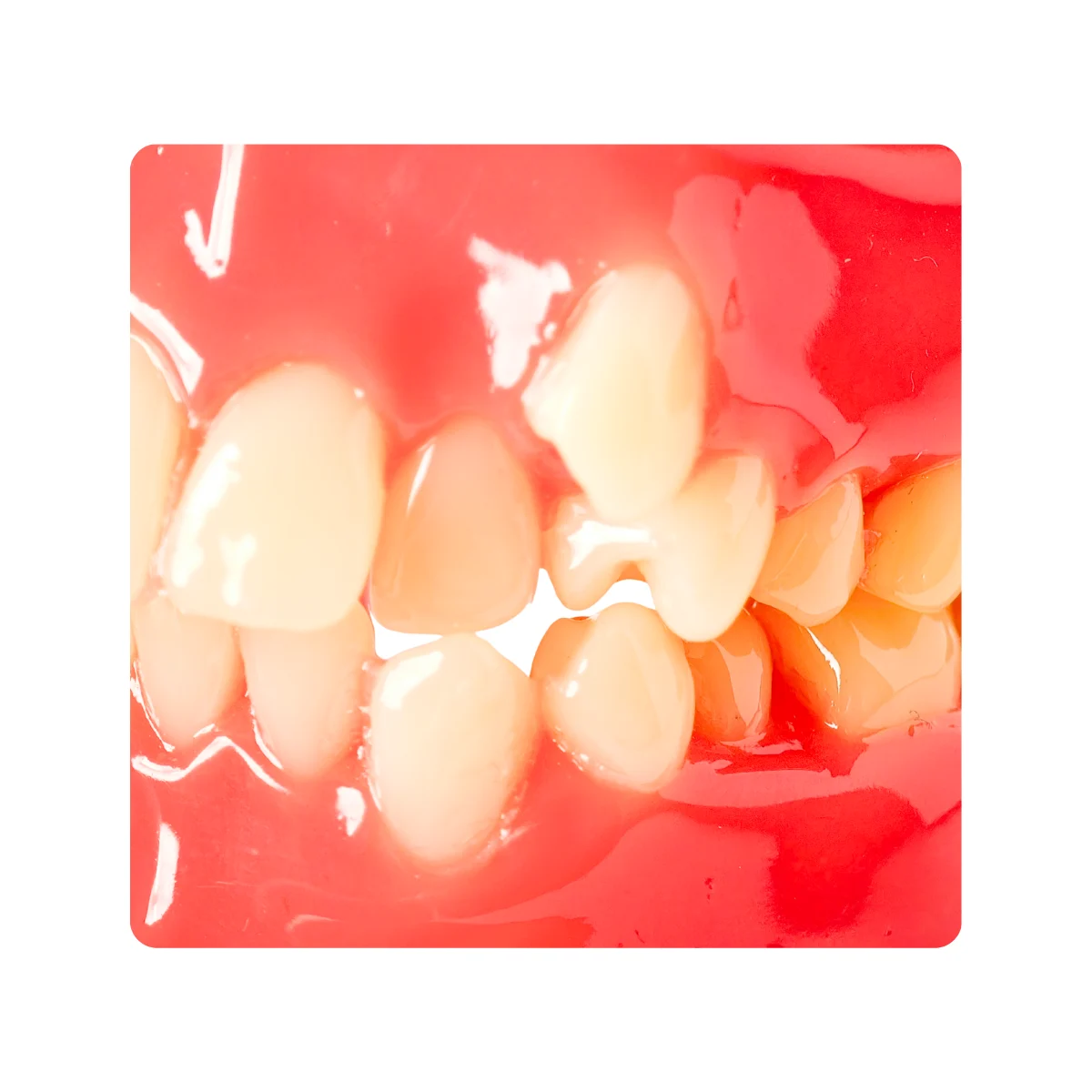 Evodent Class I Malocclusion Orthodontic Dental Model - Occlusion And Alignment Demonstration, Pink | Buy Now At Evodent Evodent orthodontic model class i malocclusion pink