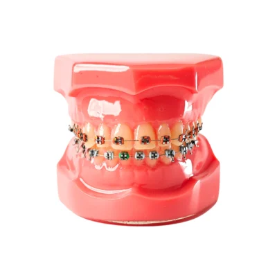 Evodent Orthodontic Model with Metal Bracket detailed dental model featuring upper and lower arches equipped with metal braces Used for orthodontic demonstrations to show how brackets attach to each tooth