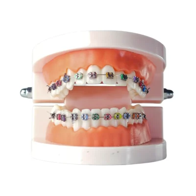 Evodent Orthodontic Model With Metal Braces With Colorful Ligatures, Patient Education Typodont Evodent orthodontic model with metal braces with colorful ligatures, patient education typodont