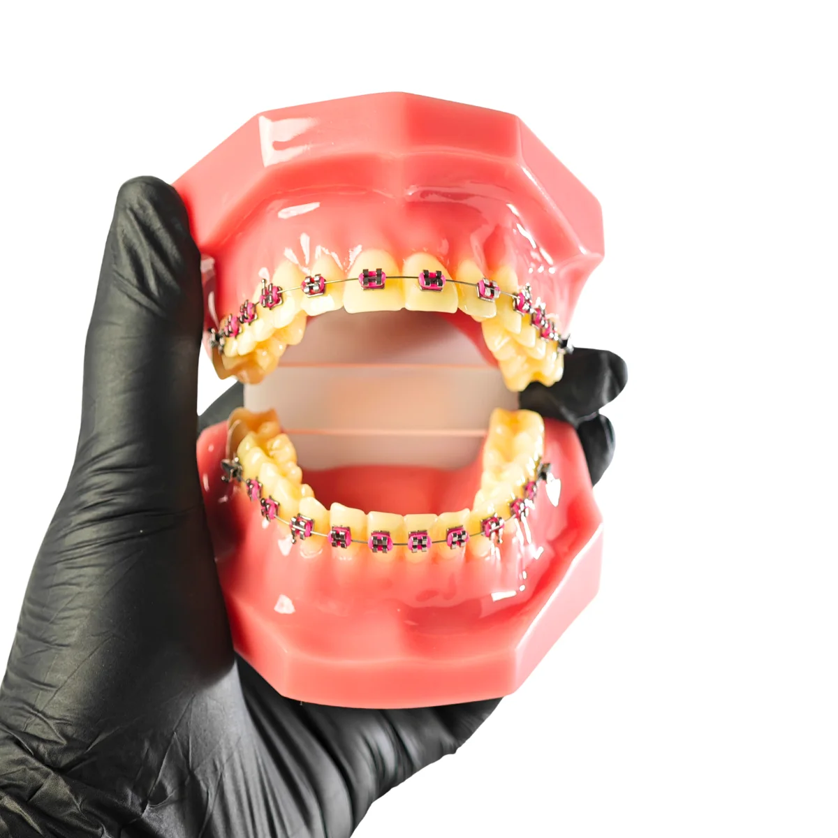 Evodent Orthodontic Model With Metal Braces And Pink Ligatures - Dental Braces Patient Education Model | Buy Now At Evodent Evodent orthodontic model with metal braces and pink ligatures - dental braces patient education model