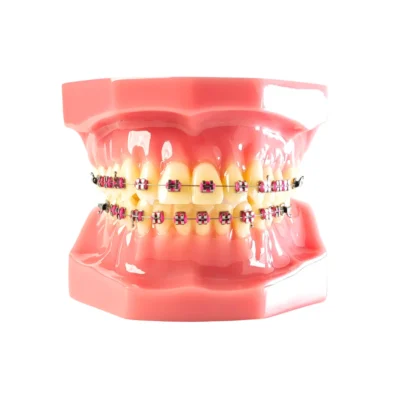 Evodent Orthodontic Model with Metal Braces and Pink Ligatures - Dental Braces Patient Education Model
