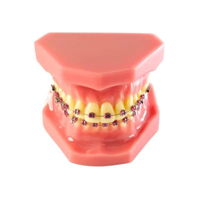 Evodent Orthodontic Model with Metal Braces and Pink Ligatures - Dental Braces Patient Education Model