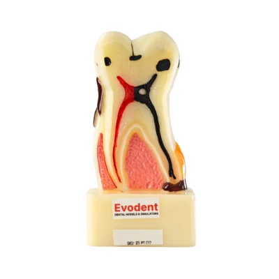 Evodent Tooth Cross-Section Model - Caries, Pulpitis, Periodontal Infection and Lesion Progression (Patient Education Model)