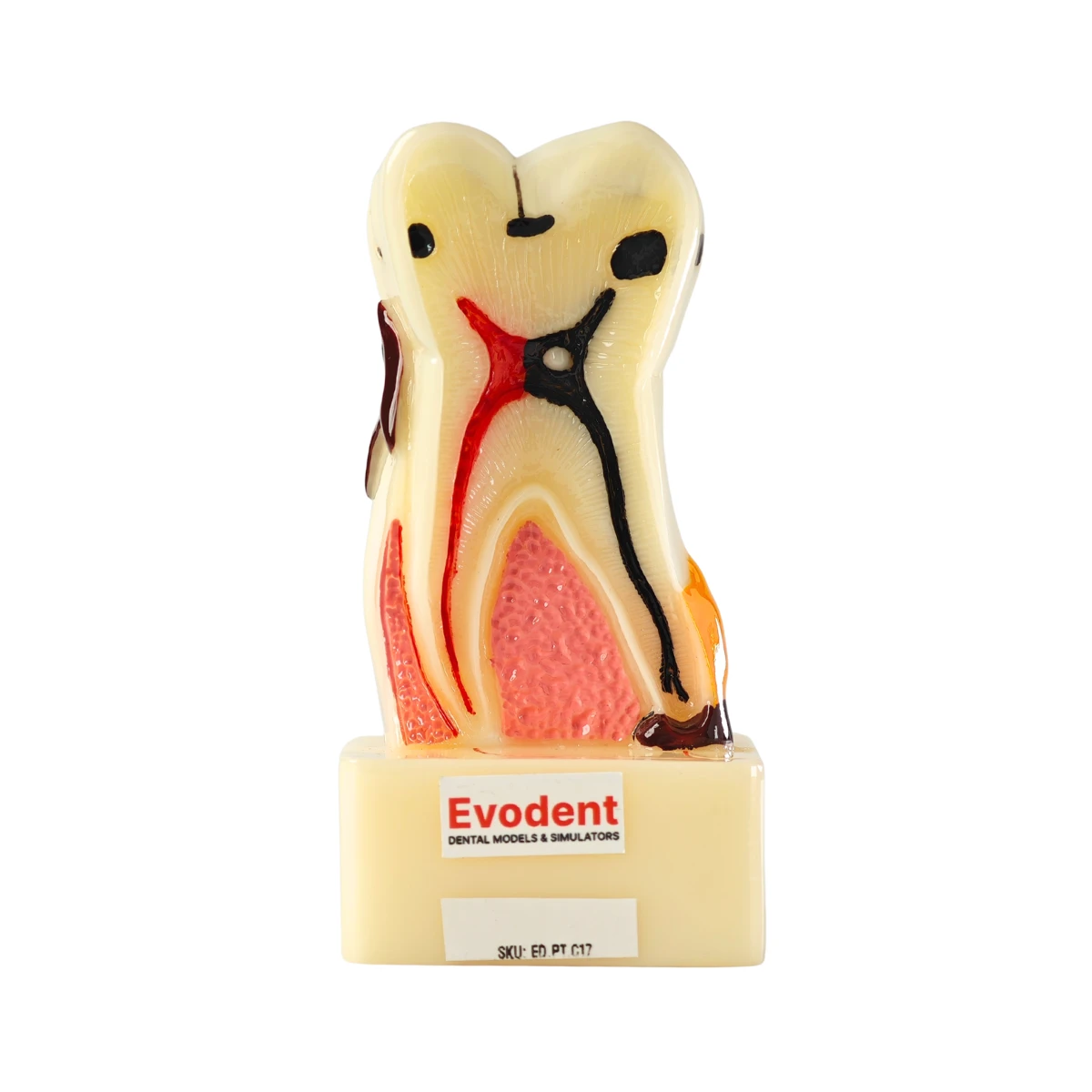 Evodent Tooth Cross-Section Model - Caries, Pulpitis, Periodontal Infection And Lesion Progression (Patient Education Model) | Buy Now At Evodent Evodent tooth cross-section model - caries, pulpitis, periodontal infection and lesion progression (patient education model)