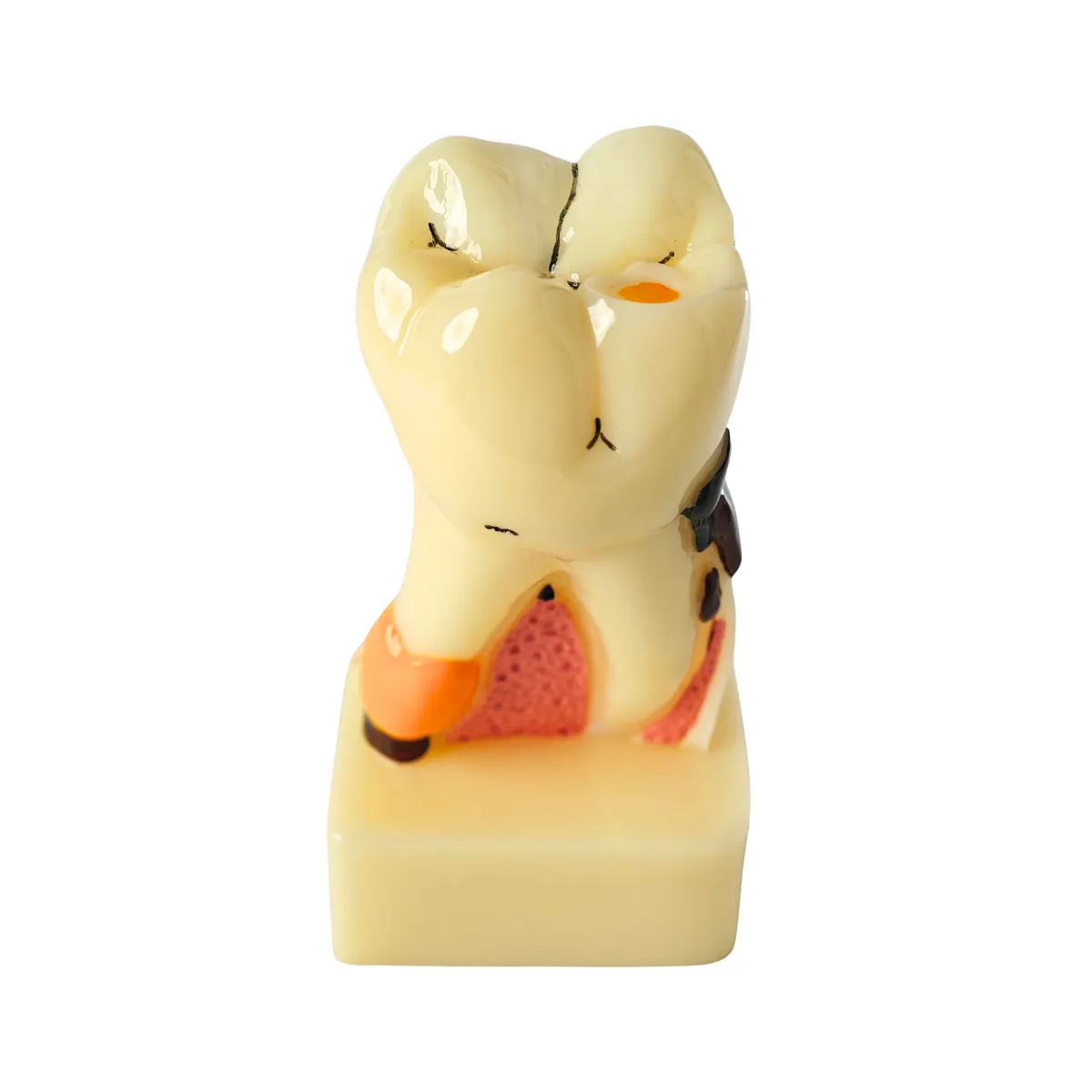 Evodent Tooth Cross-Section Model - Caries, Pulpitis, Periodontal Infection And Lesion Progression (Patient Education Model) | Buy Now At Evodent Evodent periodontal disease model with tooth cross section