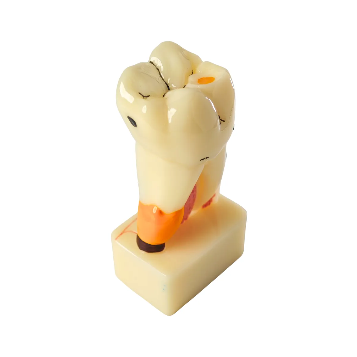 Evodent Tooth Cross-Section Model - Caries, Pulpitis, Periodontal Infection And Lesion Progression (Patient Education Model) | Buy Now At Evodent Evodent periodontal disease model with tooth cross section