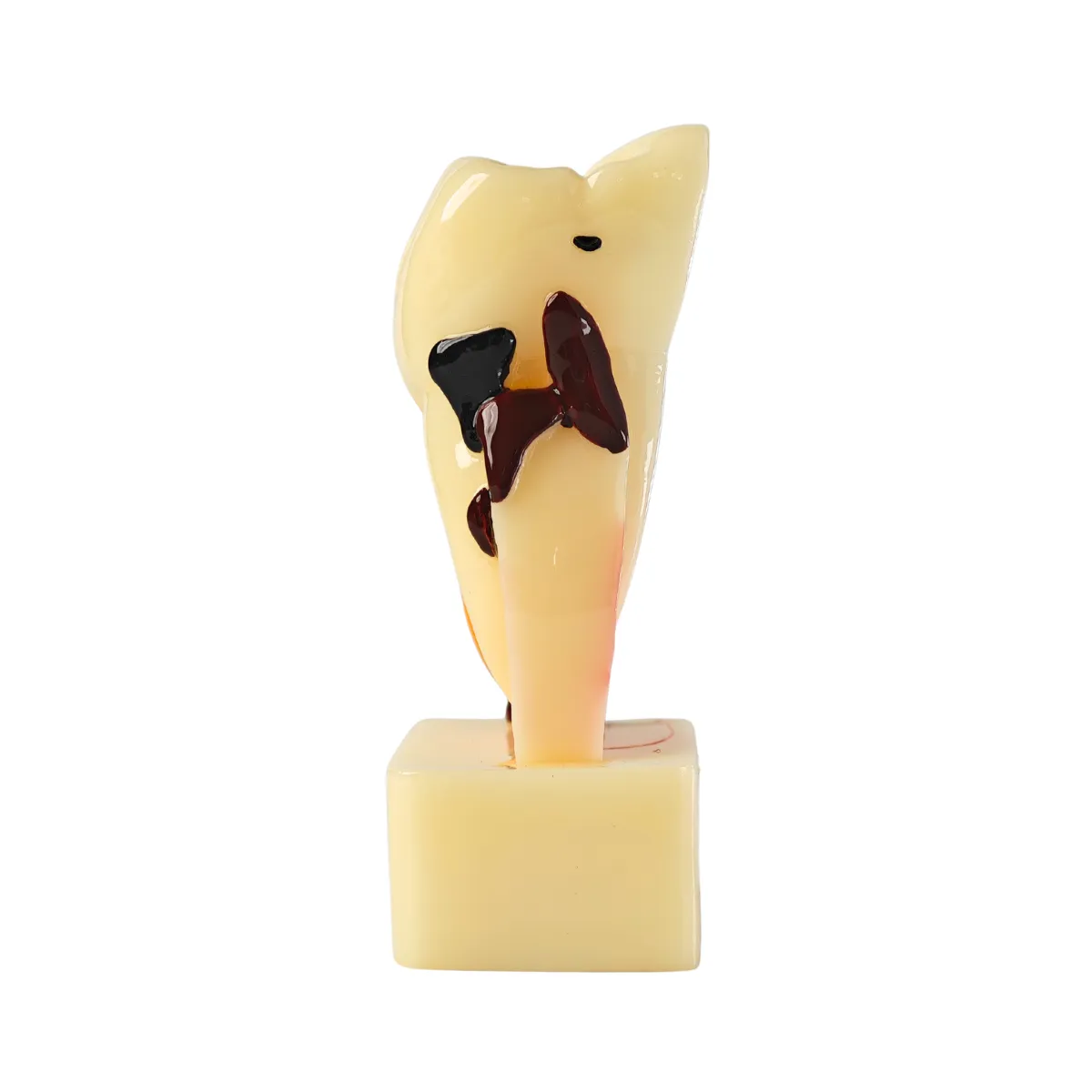 Evodent Tooth Cross-Section Model - Caries, Pulpitis, Periodontal Infection And Lesion Progression (Patient Education Model) | Buy Now At Evodent Evodent periodontal disease model with tooth cross section