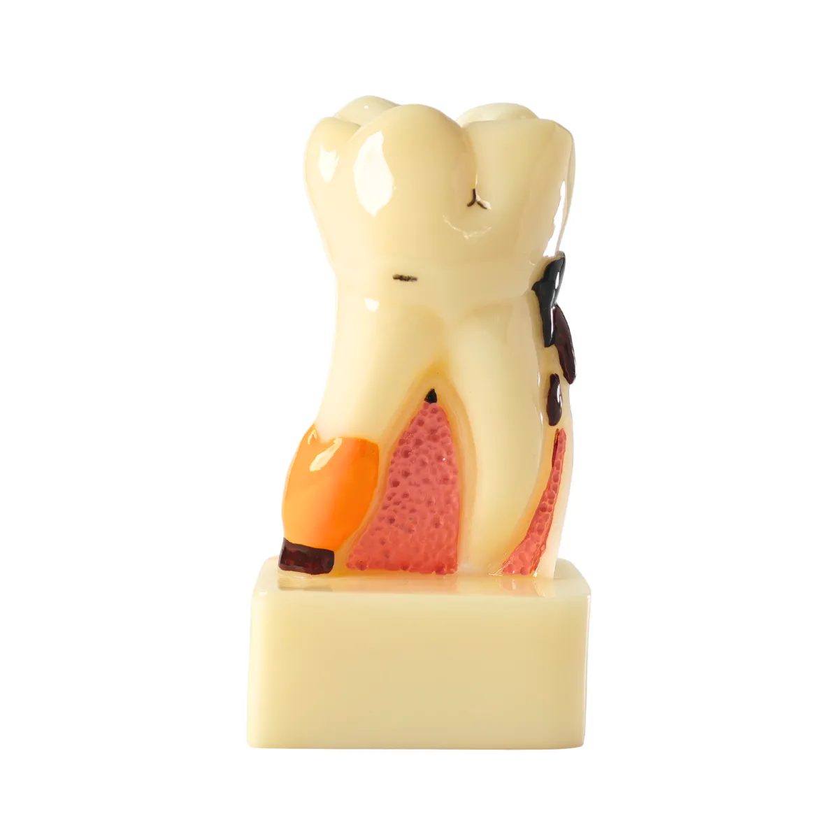 Evodent Tooth Cross-Section Model - Caries, Pulpitis, Periodontal Infection And Lesion Progression (Patient Education Model) | Buy Now At Evodent Evodent periodontal disease model with tooth cross section