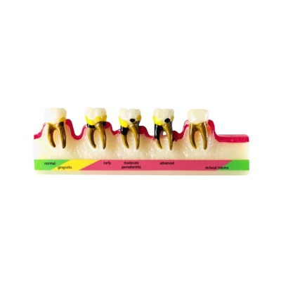 Evodent Periodontal Disease Progression Model - Gingivitis to Advanced Periodontitis & Occlusal Trauma