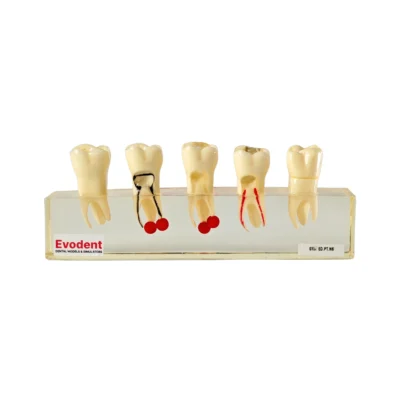 Evodent Root Canal Treatment Stages Model - Caries Progression, Pulp Infection, Endodontic Instrumentation and Gutta-Percha Filling Demonstration