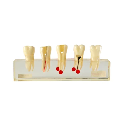 Evodent Root Canal Treatment Stages Model - Caries Progression, Pulp Infection, Endodontic Instrumentation and Gutta-Percha Filling Demonstration