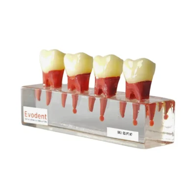 Evodent Root Canal Treatment RCT Stages Model - Caries, Pulp Exposure, Endodontic Filling and Post Core Demonstration