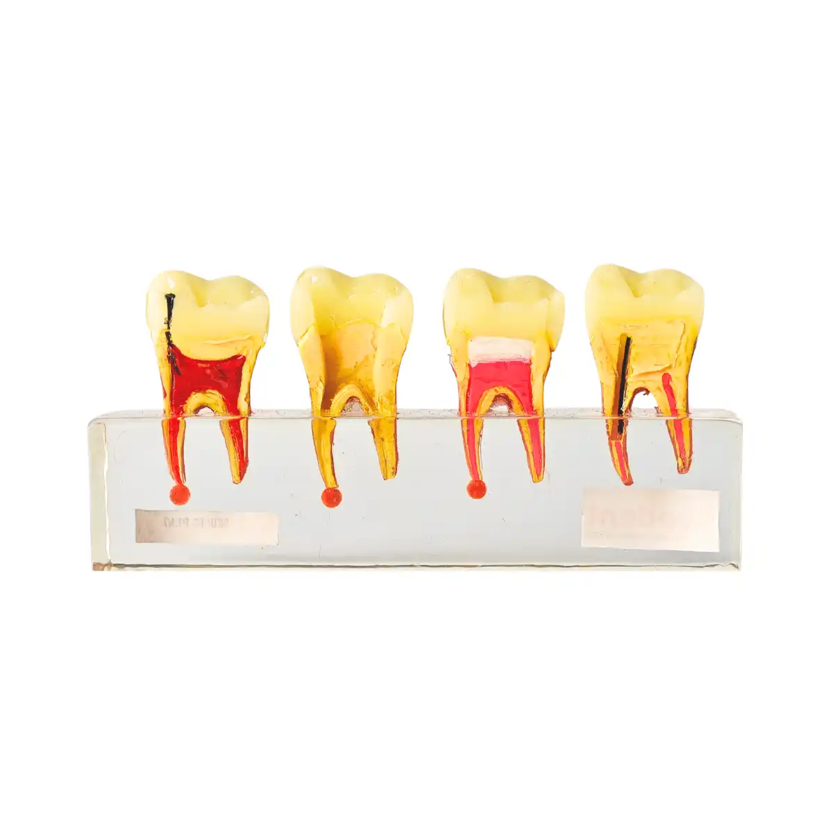 Evodent Root Canal Treatment Rct Stages Model - Caries, Pulp Exposure, Endodontic Filling And Post Core Demonstration | Buy Now At Evodent Evodent root canal treatment rct stages model - caries, pulp exposure, endodontic filling and post core demonstration