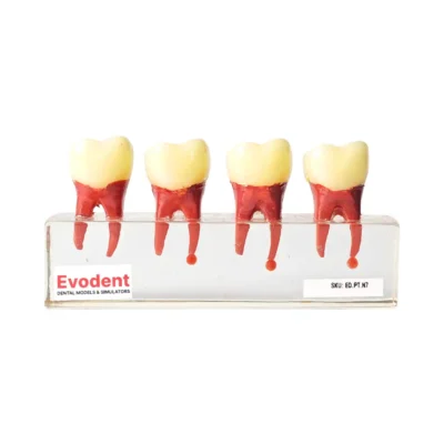 Evodent Root Canal Treatment RCT Stages Model - Caries, Pulp Exposure, Endodontic Filling and Post Core Demonstration