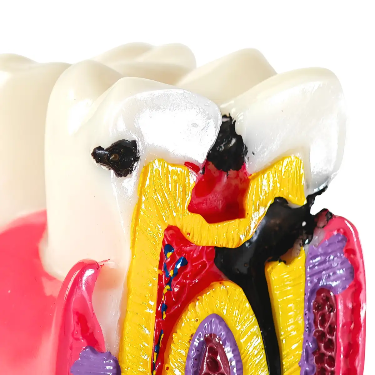 Evodent Advanced Tooth Decay Cross Section Model - Caries Progression, Pulp &Amp; Root Canal Anatomy | Buy Now At Evodent Evodent advanced tooth decay cross section model - caries progression, pulp & root canal anatomy