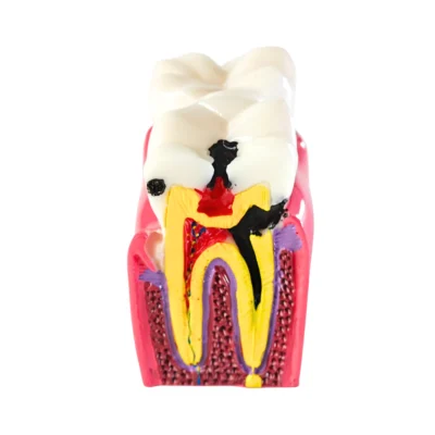 Evodent Advanced Tooth Decay Cross Section Model - Caries Progression, Pulp & Root Canal Anatomy