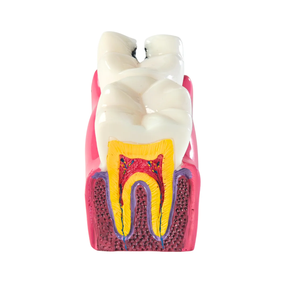 Evodent Advanced Tooth Decay Cross Section Model - Caries Progression, Pulp &Amp; Root Canal Anatomy | Buy Now At Evodent Evodent advanced tooth decay cross section model - caries progression, pulp & root canal anatomy