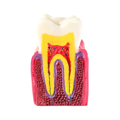 Evodent Advanced Tooth Decay Cross Section Model - Caries Progression, Pulp & Root Canal Anatomy