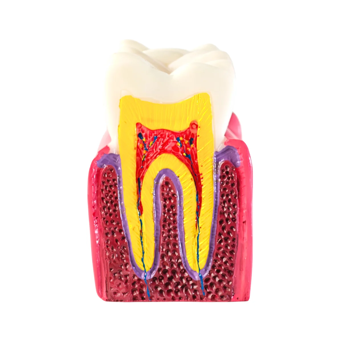 Evodent Advanced Tooth Decay Cross Section Model - Caries Progression, Pulp &Amp; Root Canal Anatomy | Buy Now At Evodent Evodent advanced tooth decay cross section model - caries progression, pulp & root canal anatomy