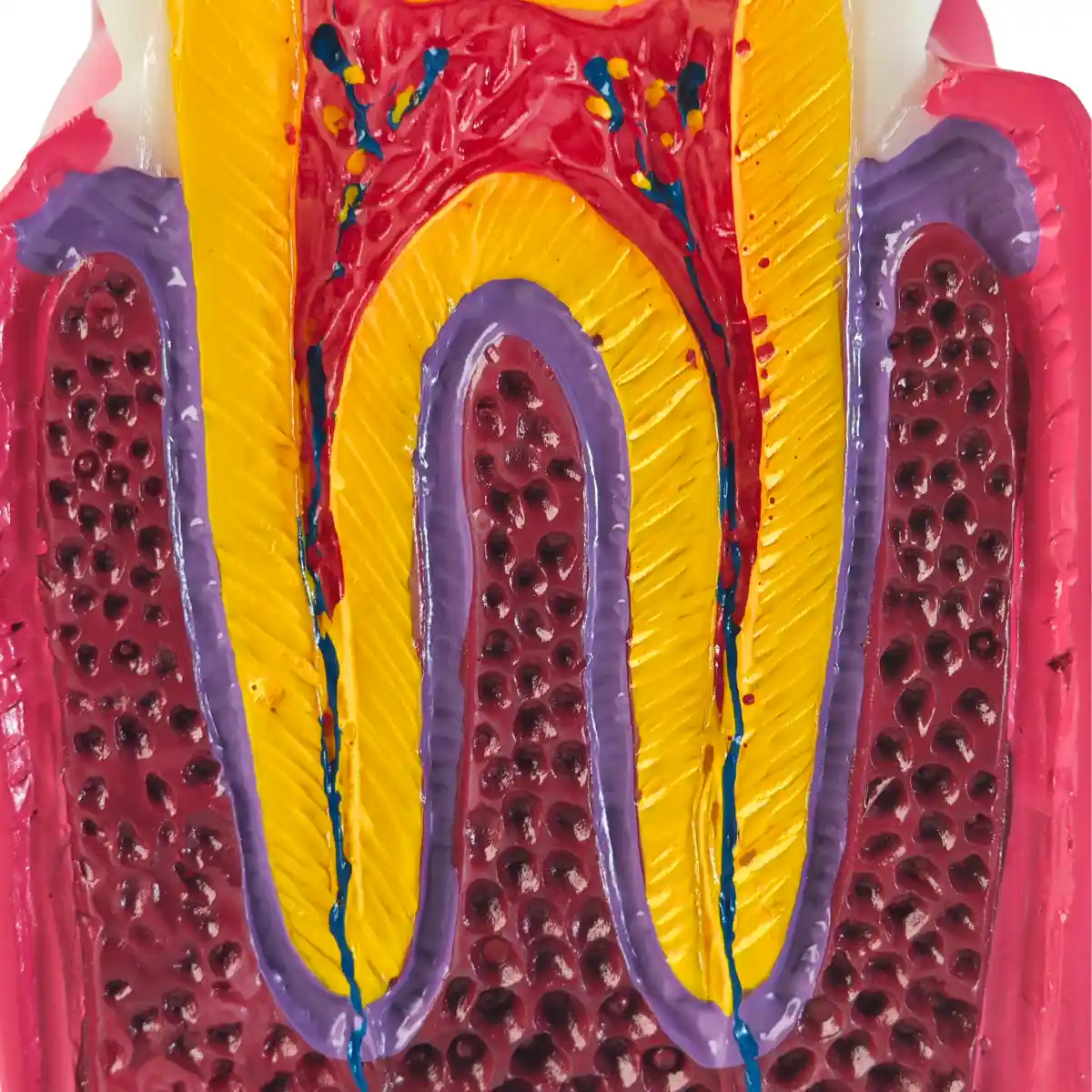 Evodent Advanced Tooth Decay Cross Section Model - Caries Progression, Pulp &Amp; Root Canal Anatomy | Buy Now At Evodent Evodent advanced tooth decay cross section model - caries progression, pulp & root canal anatomy