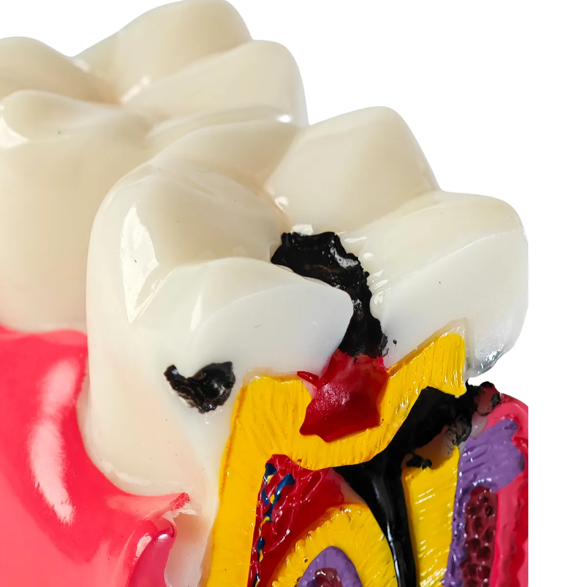 Evodent Advanced Tooth Decay Cross Section Model - Caries Progression, Pulp &Amp; Root Canal Anatomy | Buy Now At Evodent Evodent advanced tooth decay cross section model - caries progression, pulp & root canal anatomy