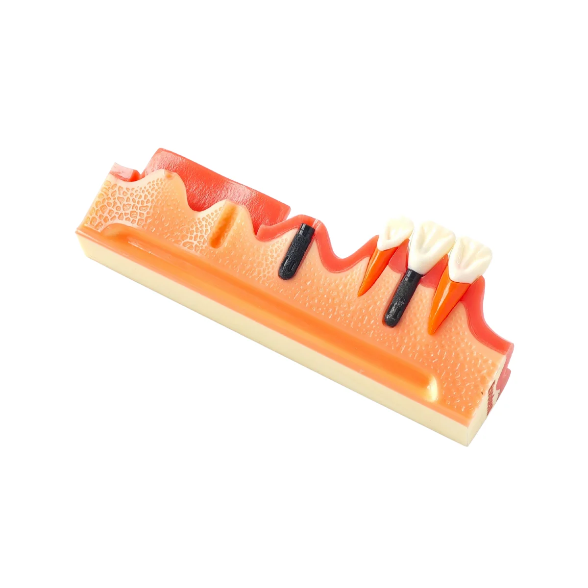 Evodent 4 Step Dental Implant Demonstration Model - Incision, Osteotomy, Implant Placement And Crown Restoration | Buy Now At Evodent Evodent 4 step dental implant demonstration model - incision, osteotomy, implant placement and crown restoration